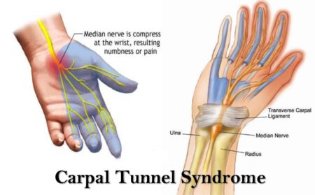 Carpal Tunnel Syndrome 4