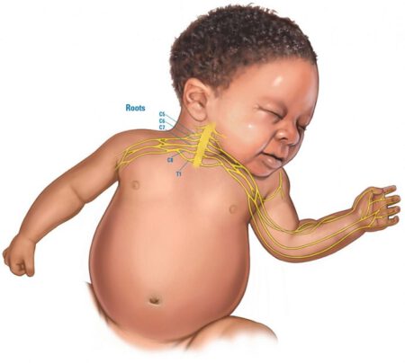 Erbs-palsy-1