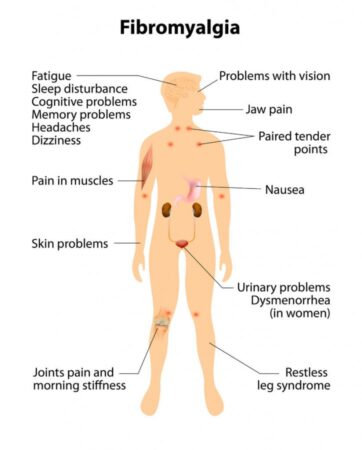 Fibromyalgia Syndrome 3