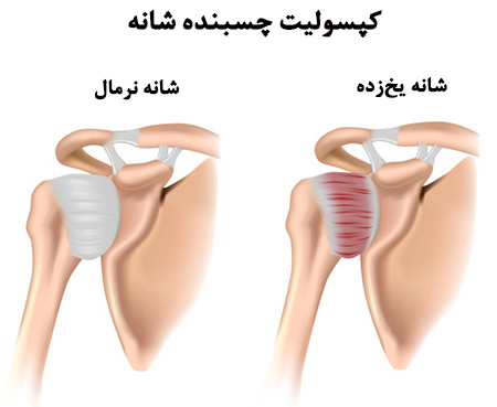 Adhesive capsulitis of shoulder