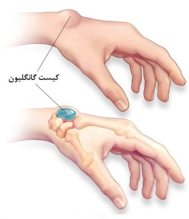 Ganglion Cyst 2