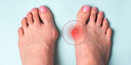 Hallux Valgus 3