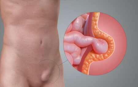 Hernia-2