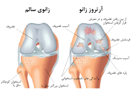 Knee Arthritis 2