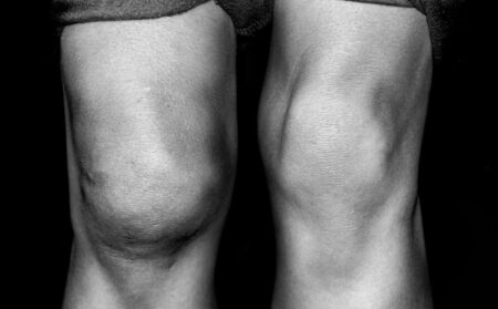 Knee Effusion 4