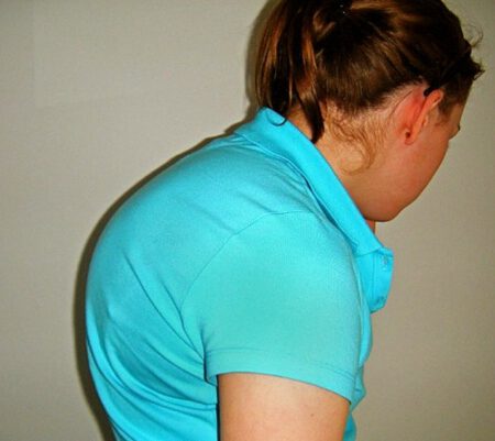 Kyphosis-2