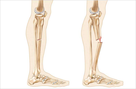 Leg-Fracture-1