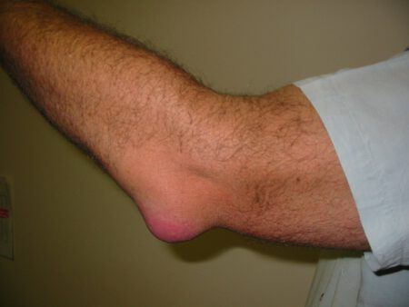 Olecranon Bursitis 2