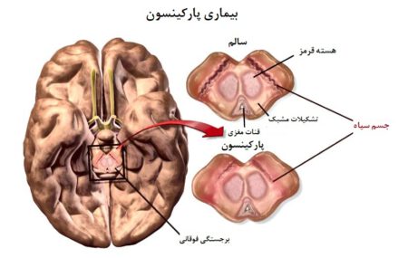 Parkinson 5