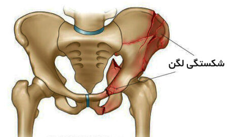 Pelvic Fracture 1
