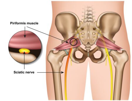 Piriformis Syndrome 3