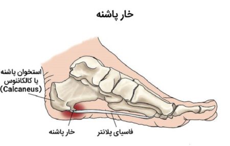Plantar Fasciitis 1