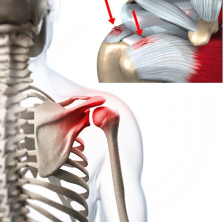 Shoulder Tendonitis 1