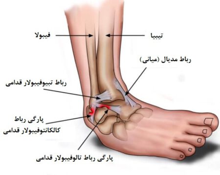 Sprained Ankle 4