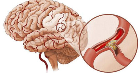 Stroke-2