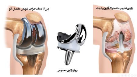 Total Knee Arthroplasty 1