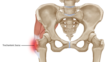 Trochanteric-Bursitis-3