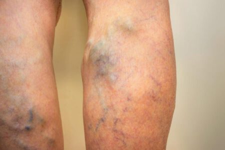 DVT