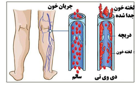 DVT
