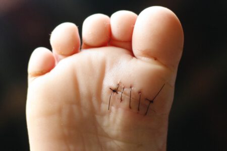 پیشگیری از عفونت، یکی از عوارض جراحی تعویض مفصل