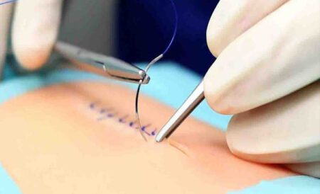 علائم عفونت پس از جراحی