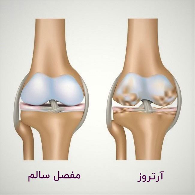 ارتوکین تراپی در شیراز توسط کلینیک فیزیوتراپی آفتاب و بهترین مرکز ارتوکین تراپی زانو در شیراز با قیمت و هزینه مناسب ارتوکین تراپی شیراز و ارتوکین تراپی زانو و لگن با کمترین عوارض ارتوکین تراپی و درمان آرتروز به روش ارتوکین تراپی در شیراز - علل آرتروز و درمان آن به روش ارتوکین تراپی