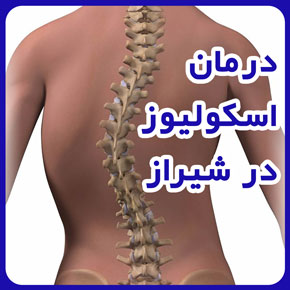درمان اسکولیوز در شیراز💥بررسی علل و علائم و تشخیص و روش‌های درمان اسکولیوز در شیراز و فیزیوتراپی و حرکات اصلاحی برای کودکان و بزرگسالان و درمان اسکولیوز خفیف و شدید و درمان اسکولیوز در خانه و بهترین مرکز درمان اسکولیوز در شیراز و هزینه درمان اسکولیوز