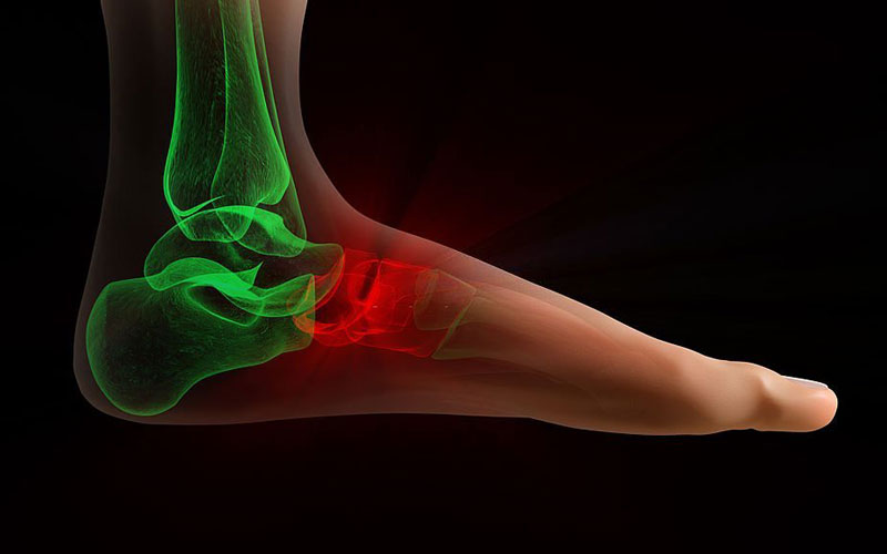 Shiraz-Ankle-Ligament-What-Is-Ankle-Ligament لیگامان مچ پا شیراز و لیست مراکز درمان لیگامان مچ پا در شیراز و بهبود شرایط رباط مچ پا با فیزیوتراپی با قیمت مناسب رزرو فوری نوبت آنلاین لیگامان مچ پا شیراز لیگامان مچ پا جلو در شیراز - لیگامان مچ پا چیست؟