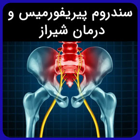 سندروم پیریفورمیس و درمان شیراز و روش‌های درمان پیریفورمیس و معرفی متخصص سندروم پیریفورمیس در شیراز با هزینه درمان در فیزیوتراپی آفتاب سندروم پیریفورمیس و درمان شیراز فوق تخصص عصب سیاتیک شیراز درمان قطعی سیاتیک در شیراز طب سوزنی برای سیاتیک در شیراز رگ گیری سیاتیک در شیراز فوق تخصص طب فیزیکی شیراز بهترین دکتر سیاتیک شیراز درمان گرفتگی عضلات لگن