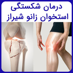 درمان شکستگی استخوان زانو شیراز و روش‌های درمان زانوی شکسته و معرفی فیزیوتراپ خوب برای درمان شکستگی استخوان زانو در فیزیوتراپی آفتاب درمان شکستگی استخوان زانو شیراز فوق تخصص زانو از امریکا در شیراز درمان خانگی شکستگی کشکک زانو بهترین دکتر زانو در شیراز نی نی سایت درمان سریع شکستگی زانو دکتر زانو در شیراز بهترین فوق تخصص زانو شیراز بهترین دکتر ساییدگی زانو شیراز دکتر برای ساییدگی زانو شیراز