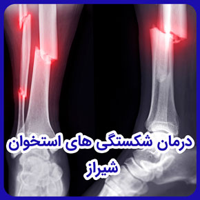 درمان شکستگی های استخوان شیراز و درمان شکستگی استخوان های کف پا و راه های درمان شکستگی استخوان و روش های درمان شکستگی استخوان پا در شیراز